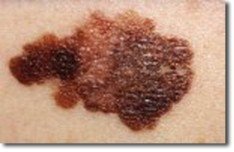 melanoma