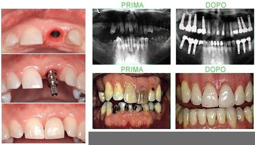 implantologia milano